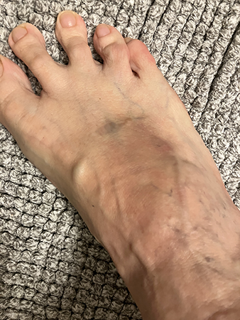 Blåmärke på högerfoten