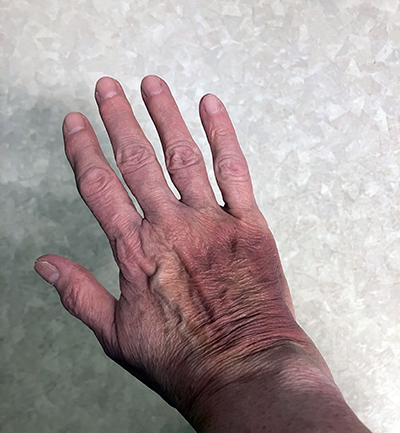 Brunmärke på högerhanden