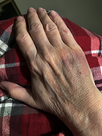 Blåmärket på handen