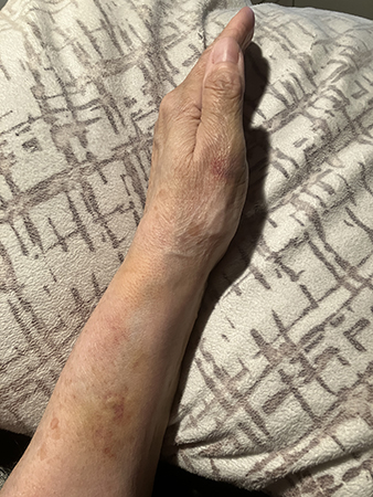Sidan vä arm o hand sju dygn efter fallet