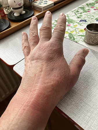 Svullen hand fredag lunch