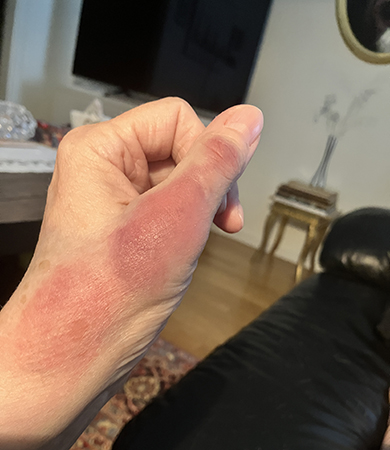 Tummen o handleden lite senare på em