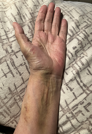 Undersidan vä arm o hand sju dygn efter fallet