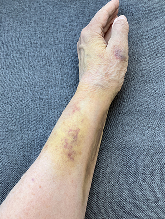 Vä arm o hand från sidan sjätte dygnet efter fallet