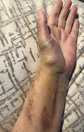 Vä arm o hand undersidan fyra dygn efter fallet
