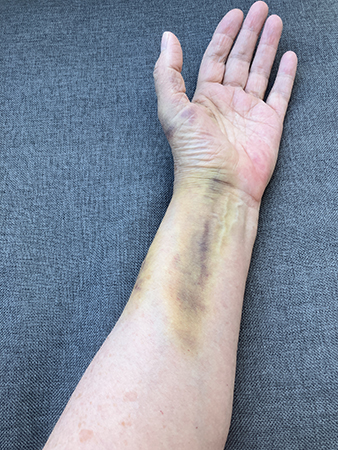 Vä arm o hand undersidan sjätte dygnet efter fallet