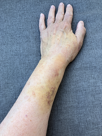 Vä arm o hand uppifrån sjätte dygnet efter fallet